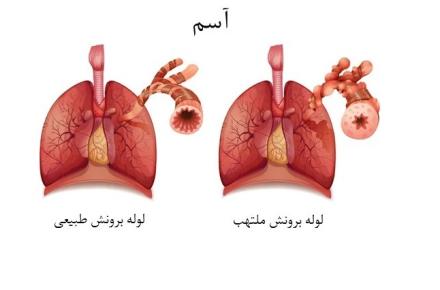 آسم چیست و چگونه ایجاد می شود؟