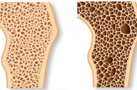 راه‌های پیشگیری از پوکی استخوان را بشناسید