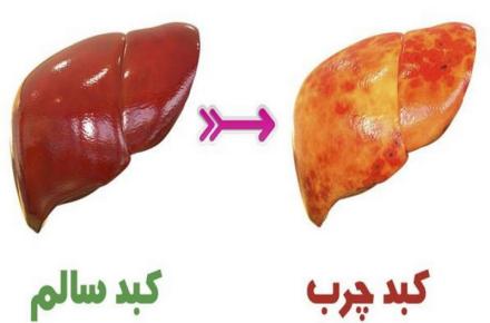 درمان کبد چرب با نسخه ابوعلی سینا