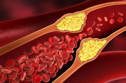 چهار علامتی که نشانه کلسترول بالاست