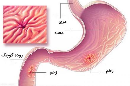 چرا زخم معده می‌گیریم؟