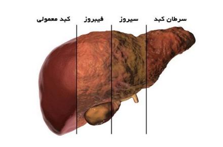 پنج عاملی که خطر ابتلا به بیماری کبدی را افزایش می‌دهد