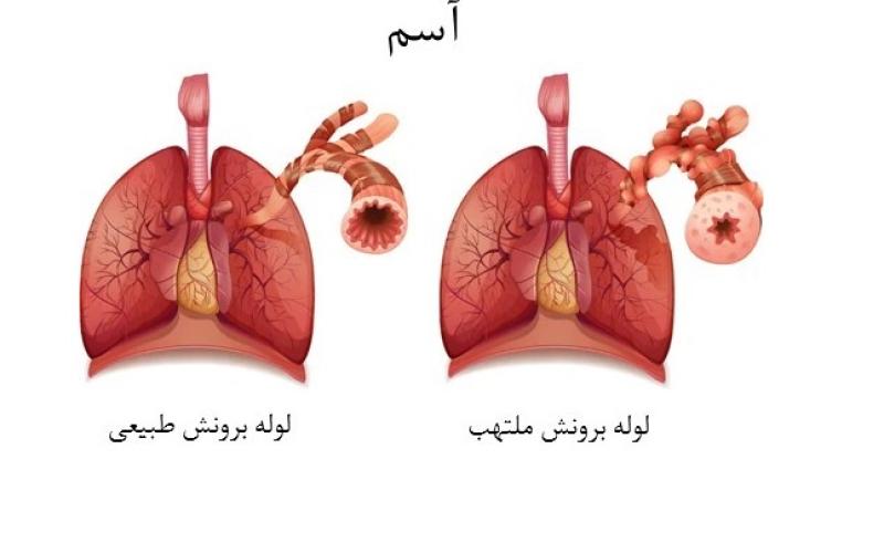 آسم چیست و چگونه ایجاد می شود؟