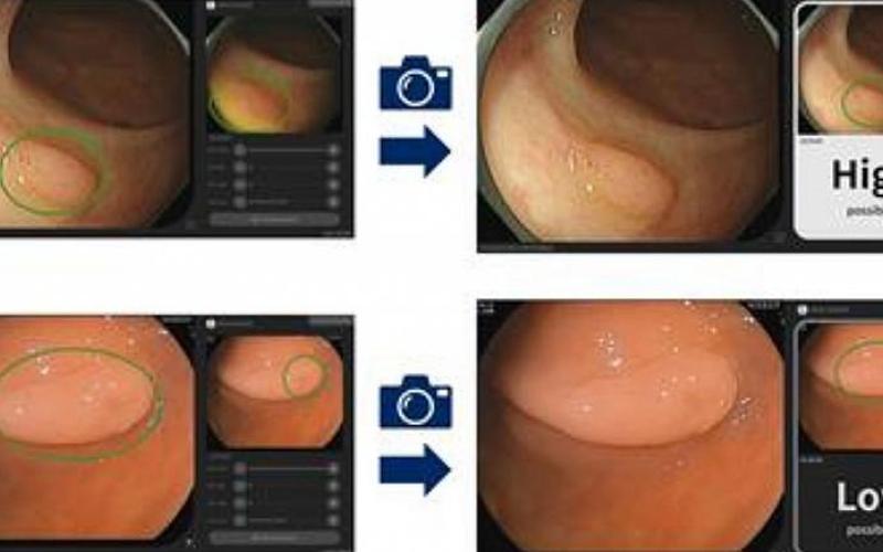 بهره‌گیری از هوش مصنوعی برای تشخیص سرطان روده در مراحل آغازین