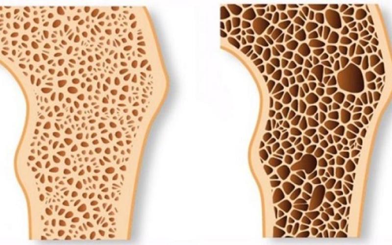 راه‌های پیشگیری از پوکی استخوان را بشناسید