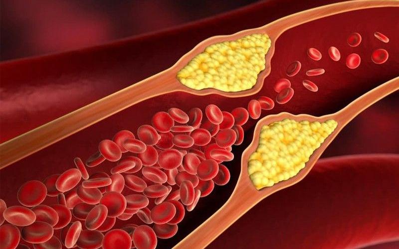 چهار علامتی که نشانه کلسترول بالاست