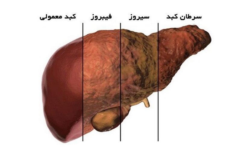 پنج عاملی که خطر ابتلا به بیماری کبدی را افزایش می‌دهد